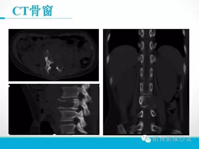 【病例】软骨母细胞瘤两例CT影像讨论 【病例】软骨母细胞瘤两例CT影像讨论