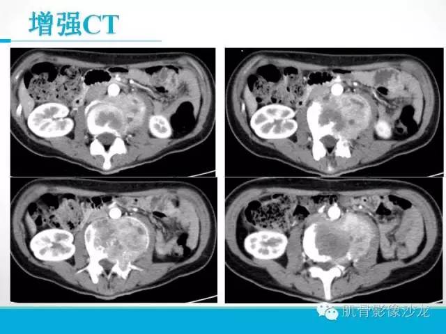 【病例】软骨母细胞瘤两例CT影像讨论 【病例】软骨母细胞瘤两例CT影像讨论