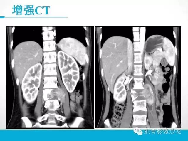 【病例】软骨母细胞瘤两例CT影像讨论 【病例】软骨母细胞瘤两例CT影像讨论