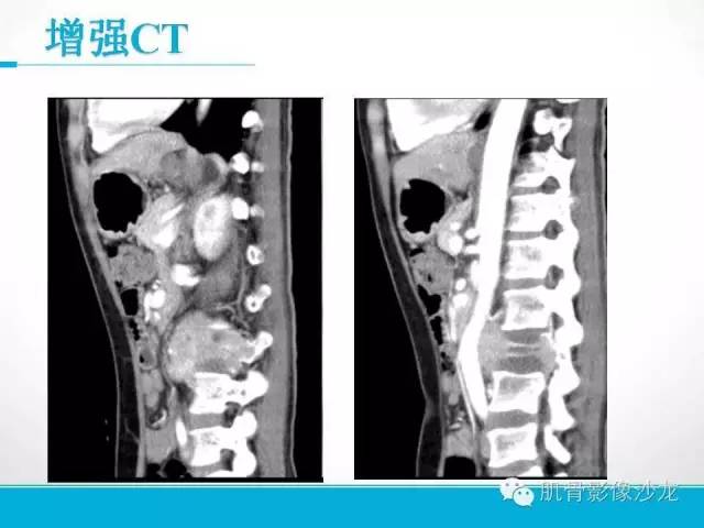 【病例】软骨母细胞瘤两例CT影像讨论 【病例】软骨母细胞瘤两例CT影像讨论