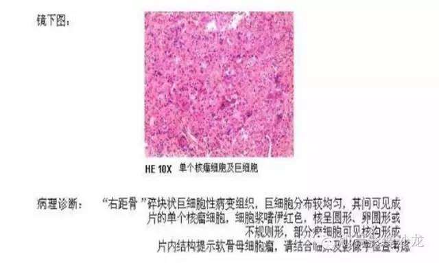 【病例】软骨母细胞瘤两例CT影像讨论 【病例】软骨母细胞瘤两例CT影像讨论