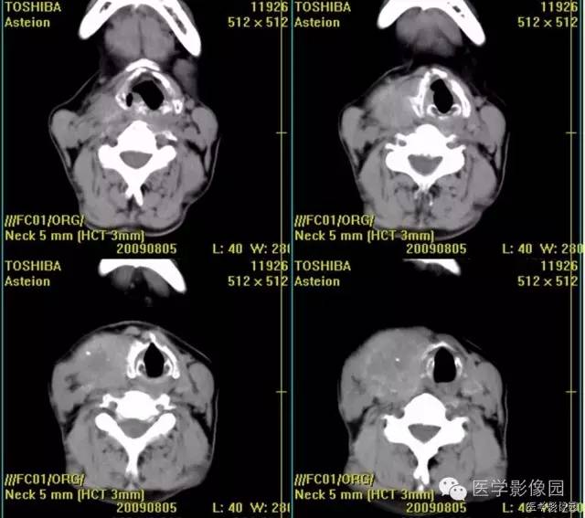 【病例】原发甲状腺血管肉瘤1例CT影像表现 【病例】原发甲状腺血管肉瘤1例CT影像表现