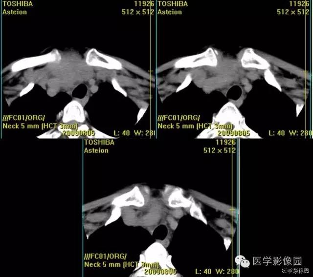 【病例】原发甲状腺血管肉瘤1例CT影像表现 【病例】原发甲状腺血管肉瘤1例CT影像表现