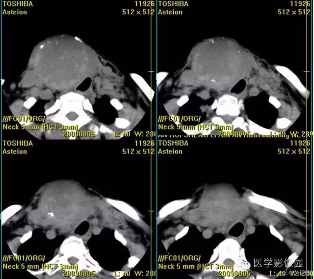 【病例】原发甲状腺血管肉瘤1例CT影像表现 【病例】原发甲状腺血管肉瘤1例CT影像表现