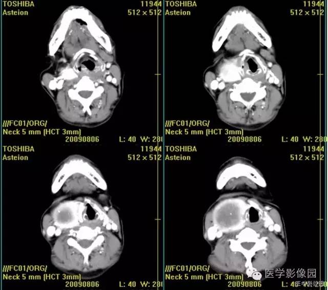 【病例】原发甲状腺血管肉瘤1例CT影像表现 【病例】原发甲状腺血管肉瘤1例CT影像表现