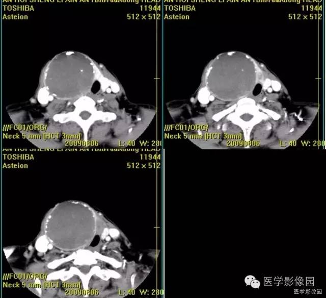 【病例】原发甲状腺血管肉瘤1例CT影像表现 【病例】原发甲状腺血管肉瘤1例CT影像表现