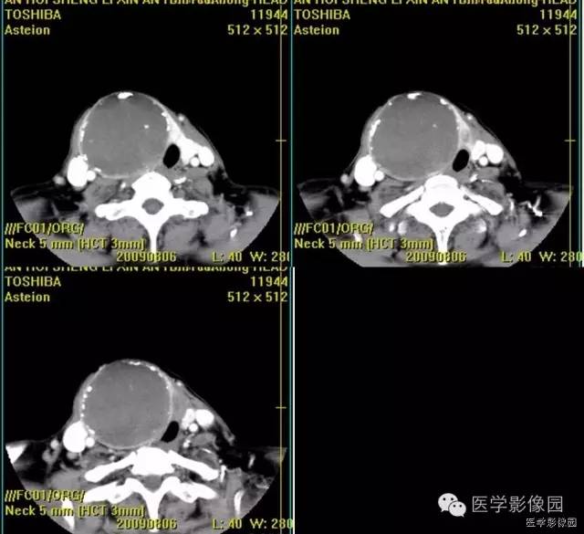 【病例】原发甲状腺血管肉瘤1例CT影像表现 【病例】原发甲状腺血管肉瘤1例CT影像表现