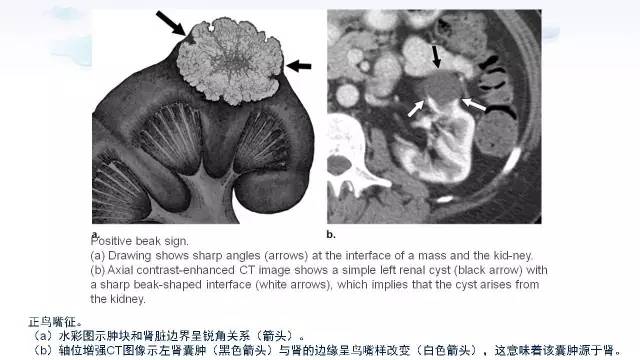 【PPT】含脂肪的腹膜后病变：影像学特点、定位及鉴别诊断