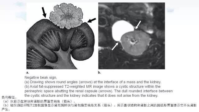 【PPT】含脂肪的腹膜后病变：影像学特点、定位及鉴别诊断