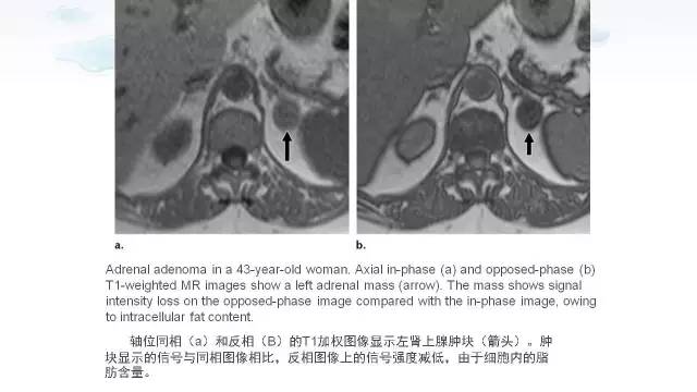 【PPT】含脂肪的腹膜后病变：影像学特点、定位及鉴别诊断