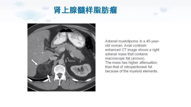 【PPT】含脂肪的腹膜后病变：影像学特点、定位及鉴别诊断