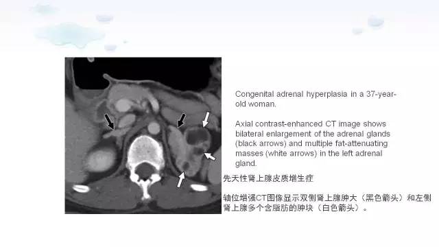 【PPT】含脂肪的腹膜后病变：影像学特点、定位及鉴别诊断
