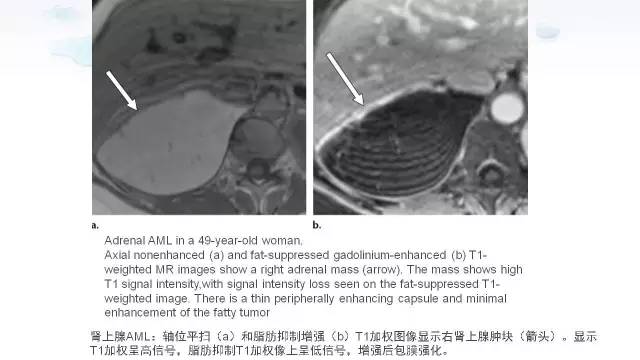 【PPT】含脂肪的腹膜后病变：影像学特点、定位及鉴别诊断