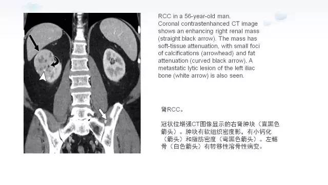 【PPT】含脂肪的腹膜后病变：影像学特点、定位及鉴别诊断