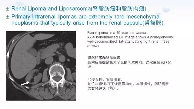 【PPT】含脂肪的腹膜后病变：影像学特点、定位及鉴别诊断