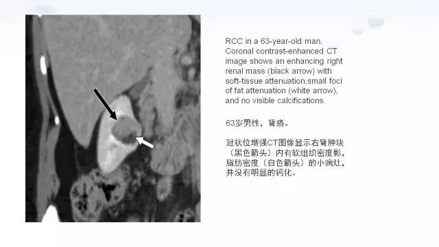 【PPT】含脂肪的腹膜后病变：影像学特点、定位及鉴别诊断