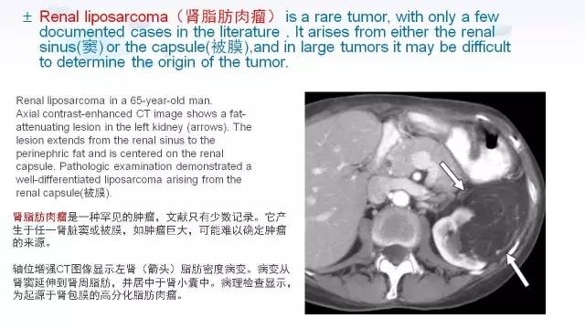 【PPT】含脂肪的腹膜后病变：影像学特点、定位及鉴别诊断