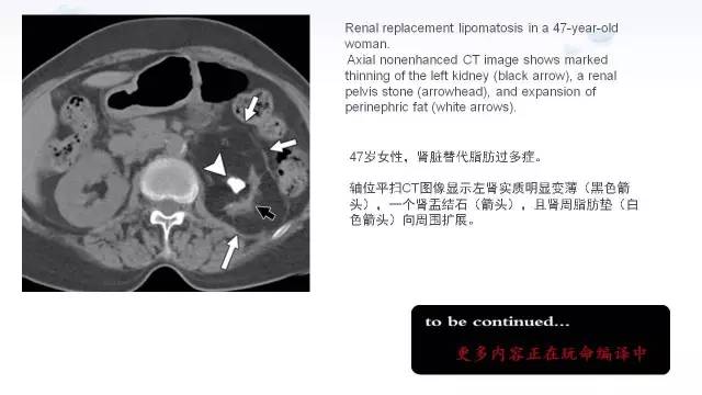 【PPT】含脂肪的腹膜后病变：影像学特点、定位及鉴别诊断