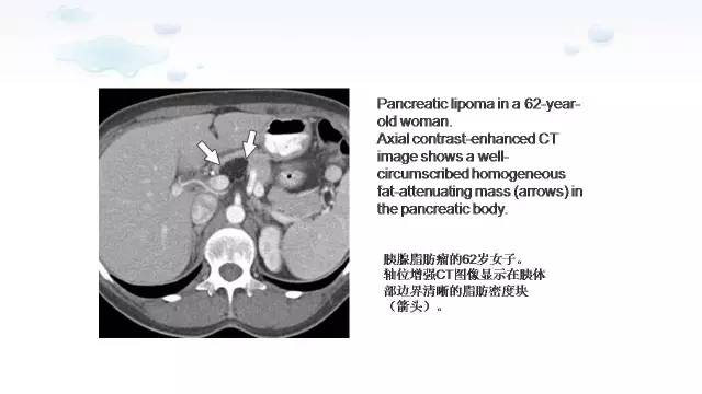 【PPT】含脂肪的腹膜后病变：影像学特点、定位及鉴别诊断