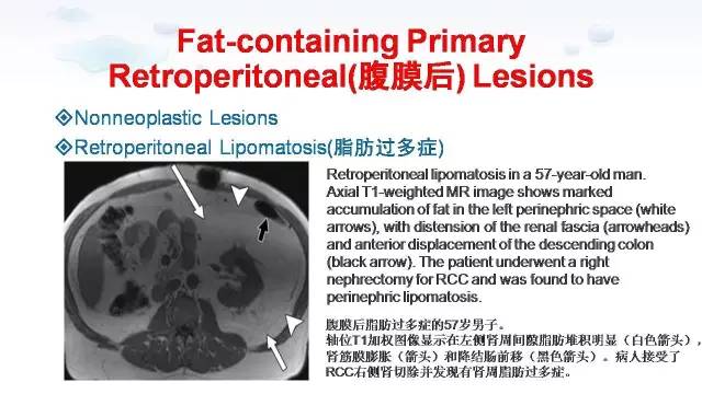 【PPT】含脂肪的腹膜后病变：影像学特点、定位及鉴别诊断