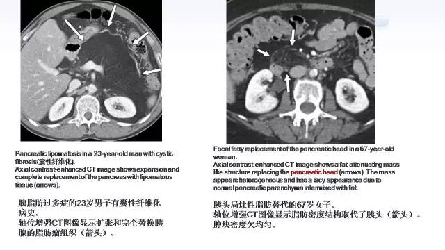 【PPT】含脂肪的腹膜后病变：影像学特点、定位及鉴别诊断