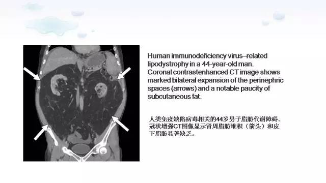【PPT】含脂肪的腹膜后病变：影像学特点、定位及鉴别诊断