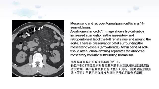 【PPT】含脂肪的腹膜后病变：影像学特点、定位及鉴别诊断