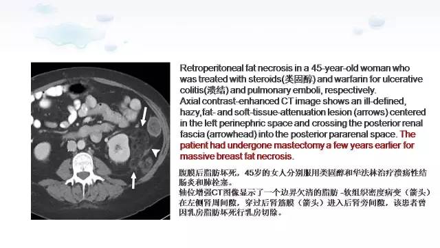 【PPT】含脂肪的腹膜后病变：影像学特点、定位及鉴别诊断