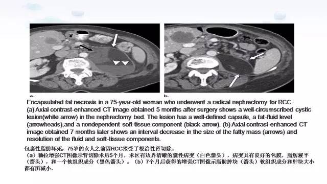 【PPT】含脂肪的腹膜后病变：影像学特点、定位及鉴别诊断
