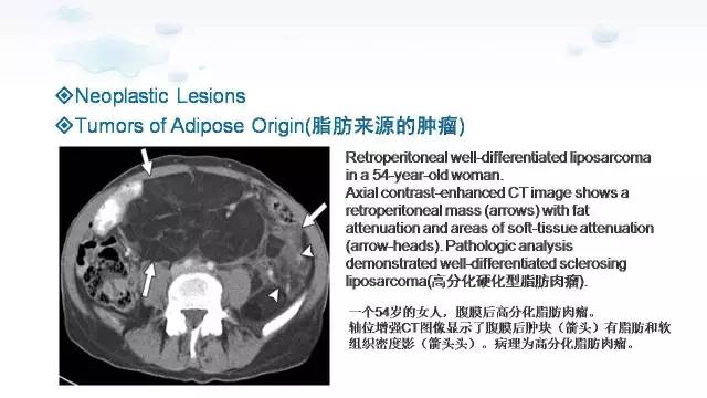 【PPT】含脂肪的腹膜后病变：影像学特点、定位及鉴别诊断