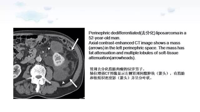 【PPT】含脂肪的腹膜后病变：影像学特点、定位及鉴别诊断