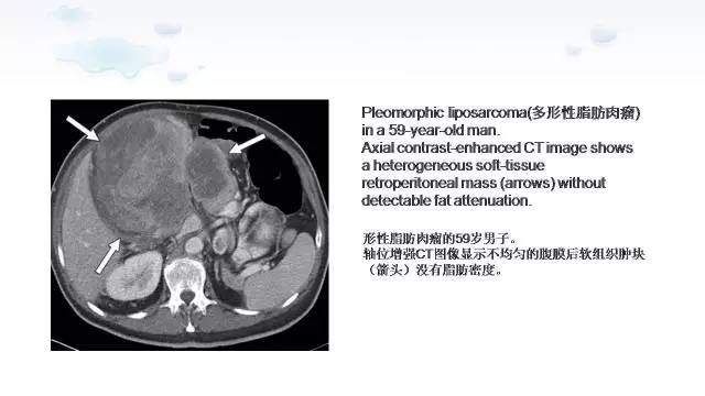 【PPT】含脂肪的腹膜后病变：影像学特点、定位及鉴别诊断