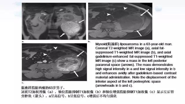 【PPT】含脂肪的腹膜后病变：影像学特点、定位及鉴别诊断