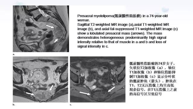 【PPT】含脂肪的腹膜后病变：影像学特点、定位及鉴别诊断