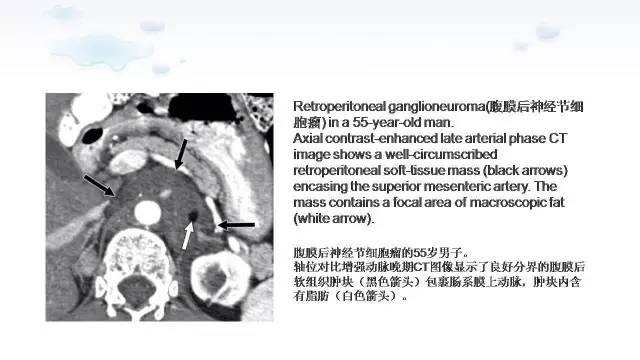 【PPT】含脂肪的腹膜后病变：影像学特点、定位及鉴别诊断