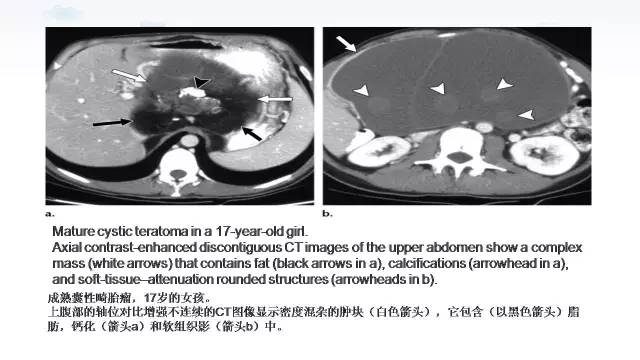 【PPT】含脂肪的腹膜后病变：影像学特点、定位及鉴别诊断