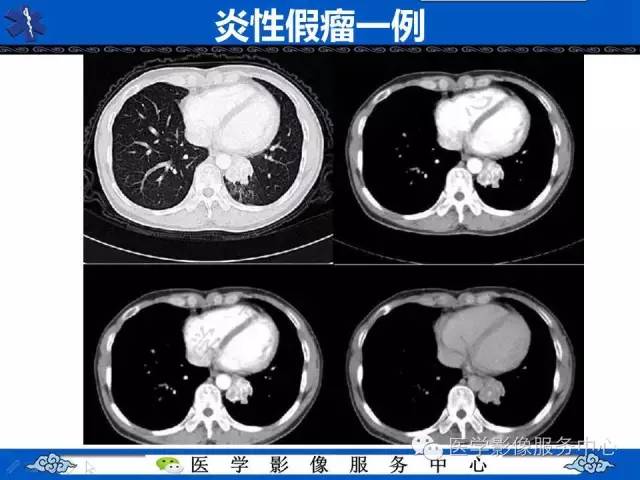 【影像征象】桃尖征