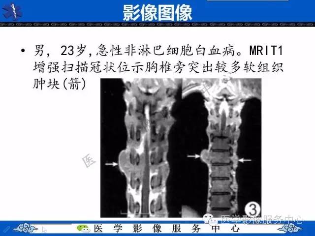 【PPT】白血病的CT、MRI诊断价值