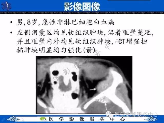 【PPT】白血病的CT、MRI诊断价值