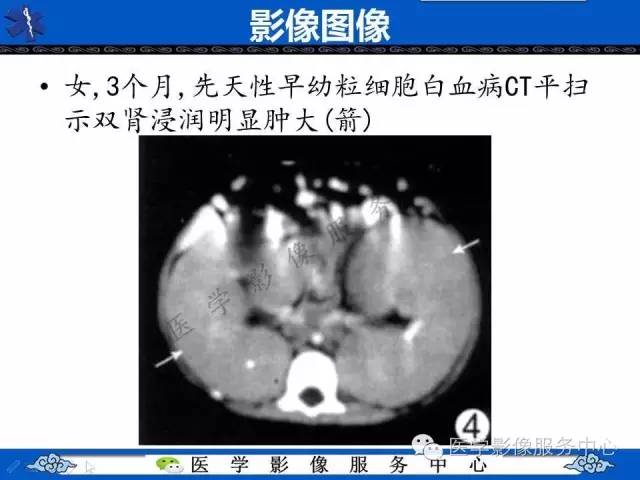 【PPT】白血病的CT、MRI诊断价值