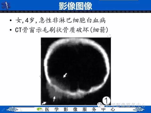 【PPT】白血病的CT、MRI诊断价值