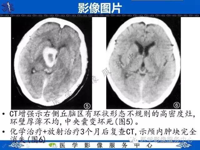 【PPT】白血病的CT、MRI诊断价值