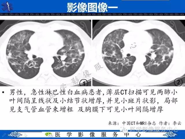 【PPT】白血病的CT、MRI诊断价值
