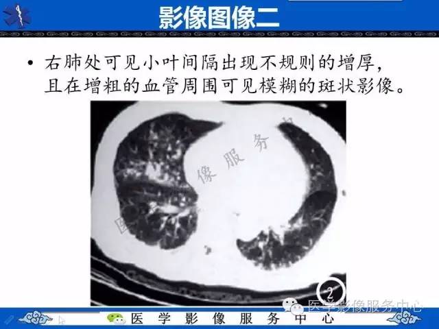 【PPT】白血病的CT、MRI诊断价值