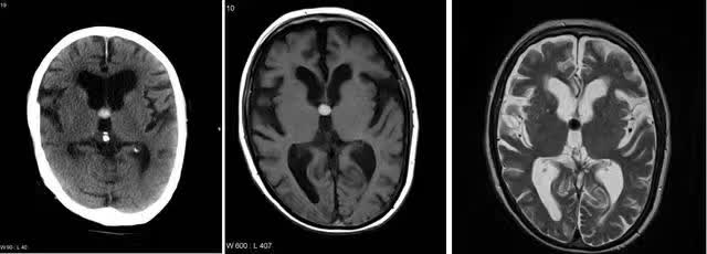 【病例】第三脑室胶样囊肿6例CT及MR影像诊断要点