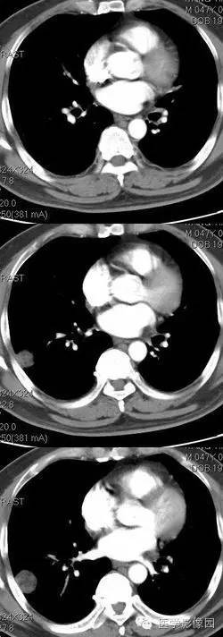 【病例】肺错构瘤1例CT影像表现 【病例】肺错构瘤1例CT影像表现