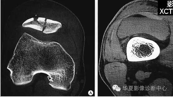 脂肪-血液界面征——关节积脂血症