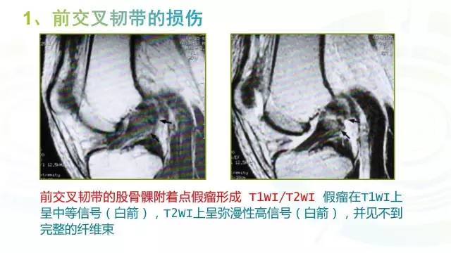 【PPT】6种膝关节周围韧带损伤，如何用MR诊断？