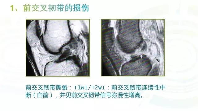 【PPT】6种膝关节周围韧带损伤，如何用MR诊断？