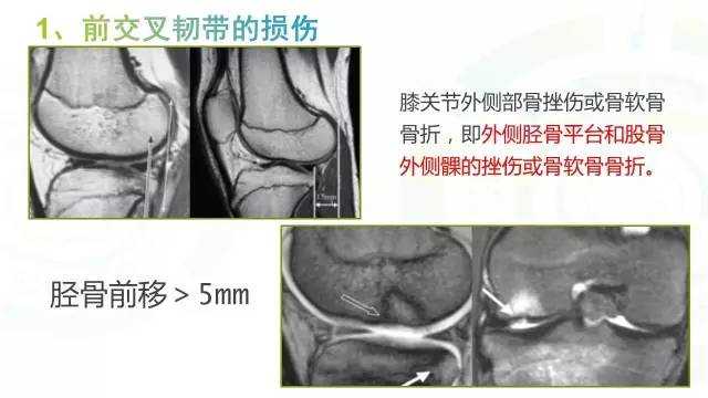 【PPT】6种膝关节周围韧带损伤，如何用MR诊断？